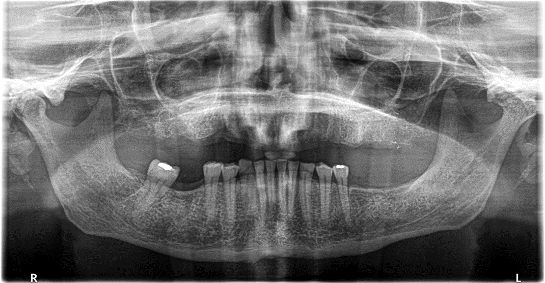 https://mexicoimplantdentistry.com/wp-content/uploads/2022/07/1.png