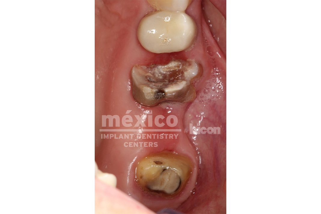 https://mexicoimplantdentistry.com/wp-content/uploads/2022/09/1.png